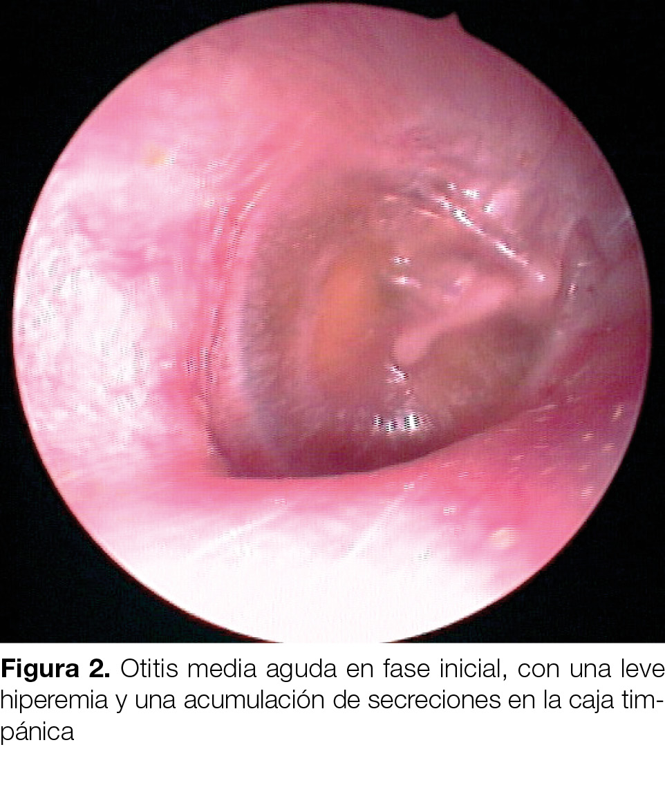 PROFESIONAL otitis media aguda fig 2