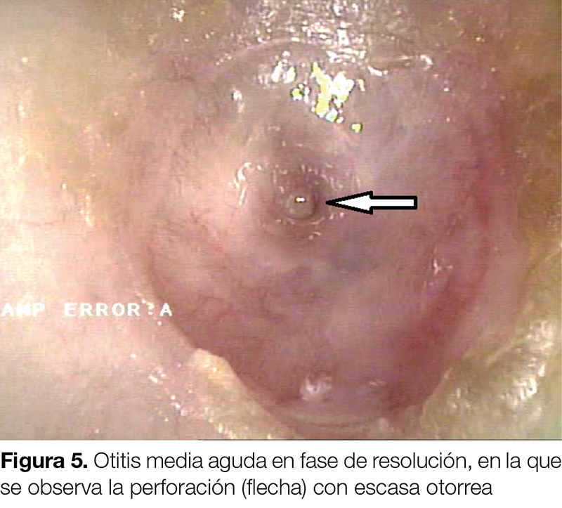 PROFESIONAL otitis media aguda fig 5